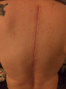 Picture of surgical scar on author's spine.